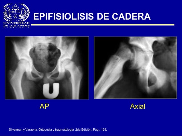 epifisiolistesis de cadera